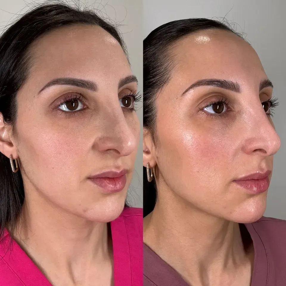 Before and after comparison of a person's profile, showing the results of a facial cosmetic procedure.