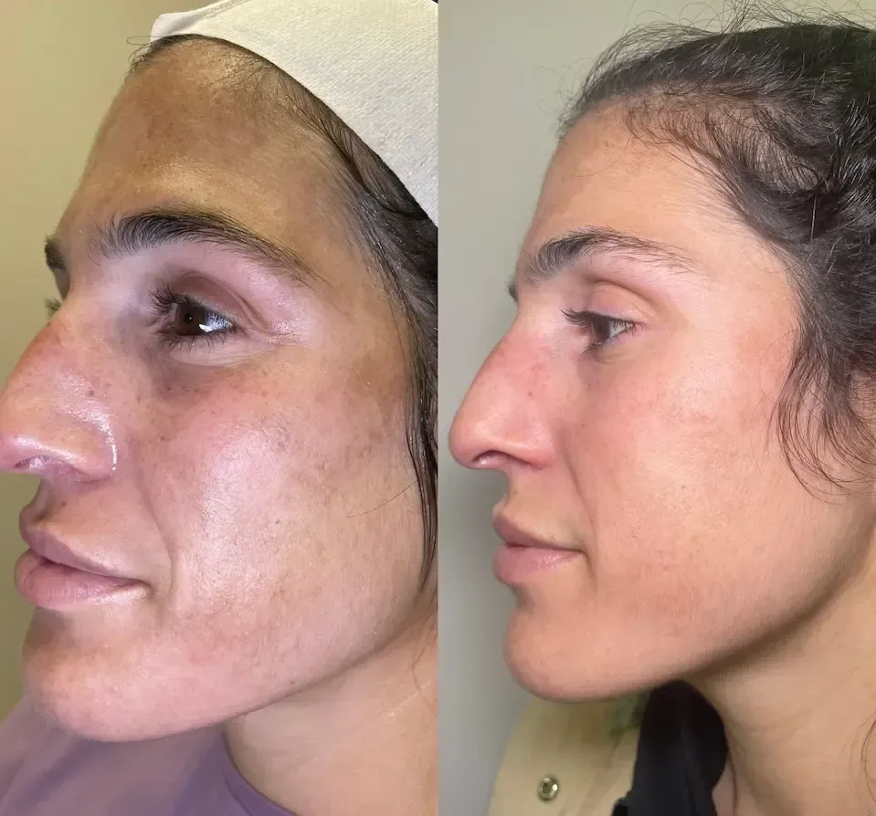 Before-and-after side-by-side comparison showing reduced skin hyperpigmentation and improved skin texture on a face.