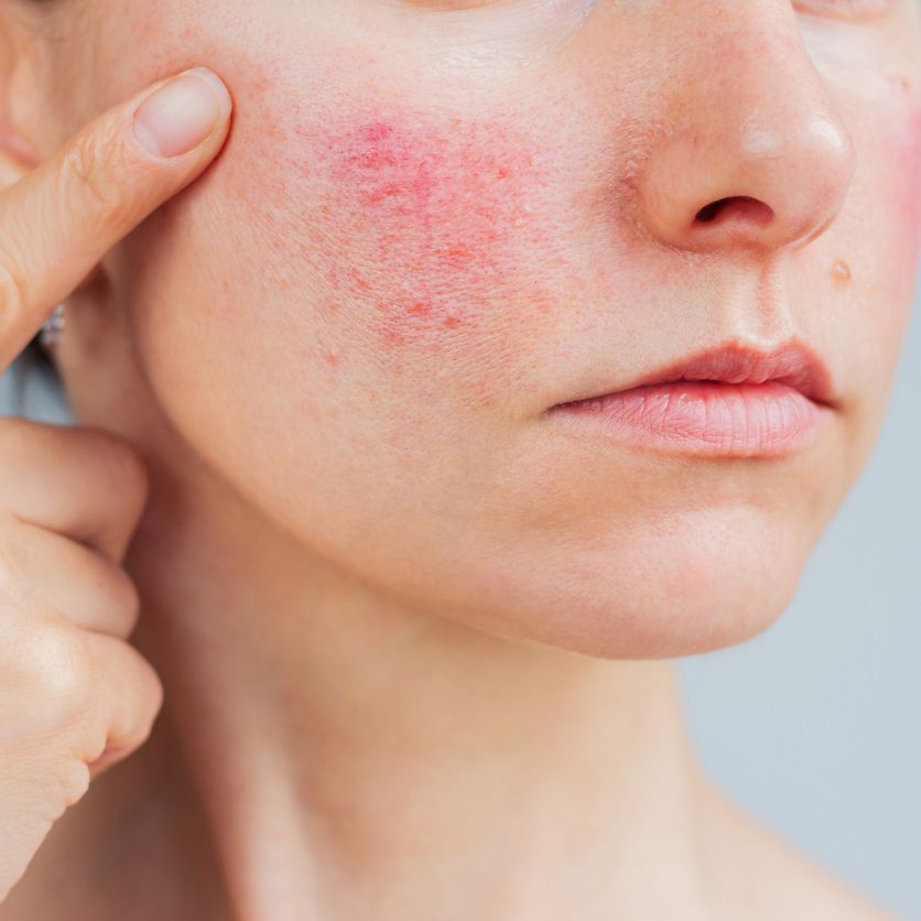 A person points to a patch of red, inflamed, and textured skin on their cheek.