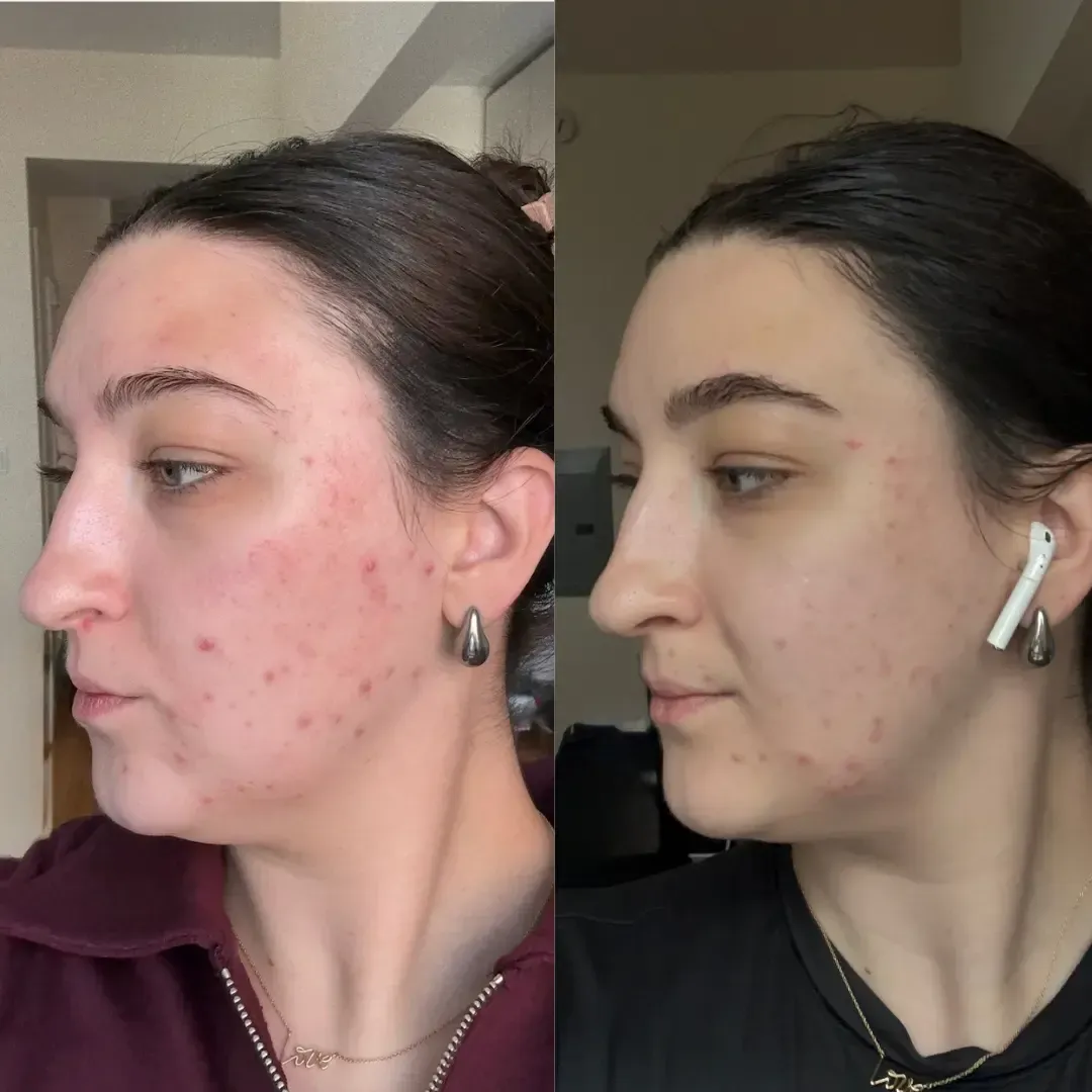 before and after image showing skin before using lumenvy skincare products