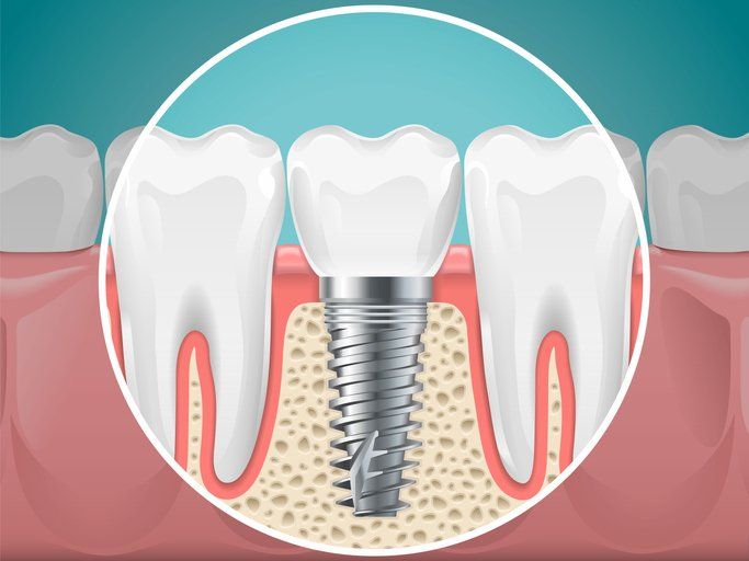 Dental Implants – Cape Girardeau, MO – Harter Family Dental