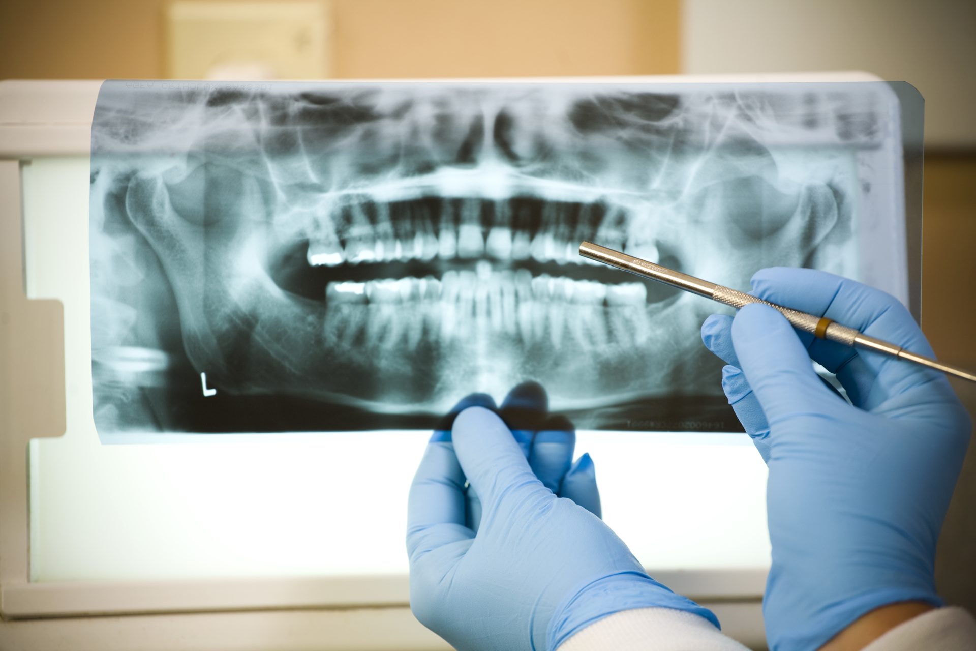 Dental Implants – Cape Girardeau, MO – Harter Family Dental
