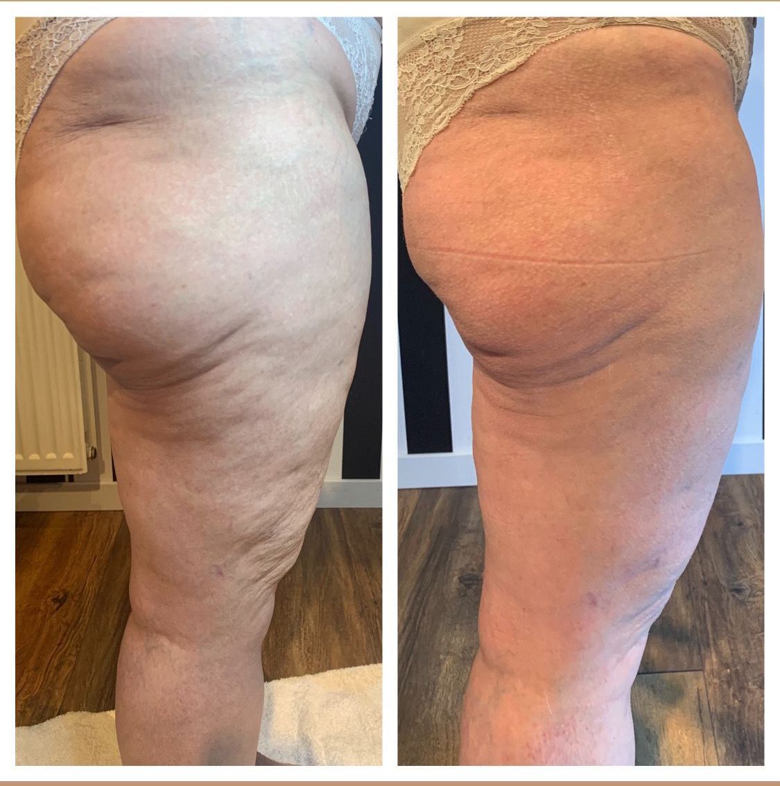 Bodywrap cellulite + afslanking