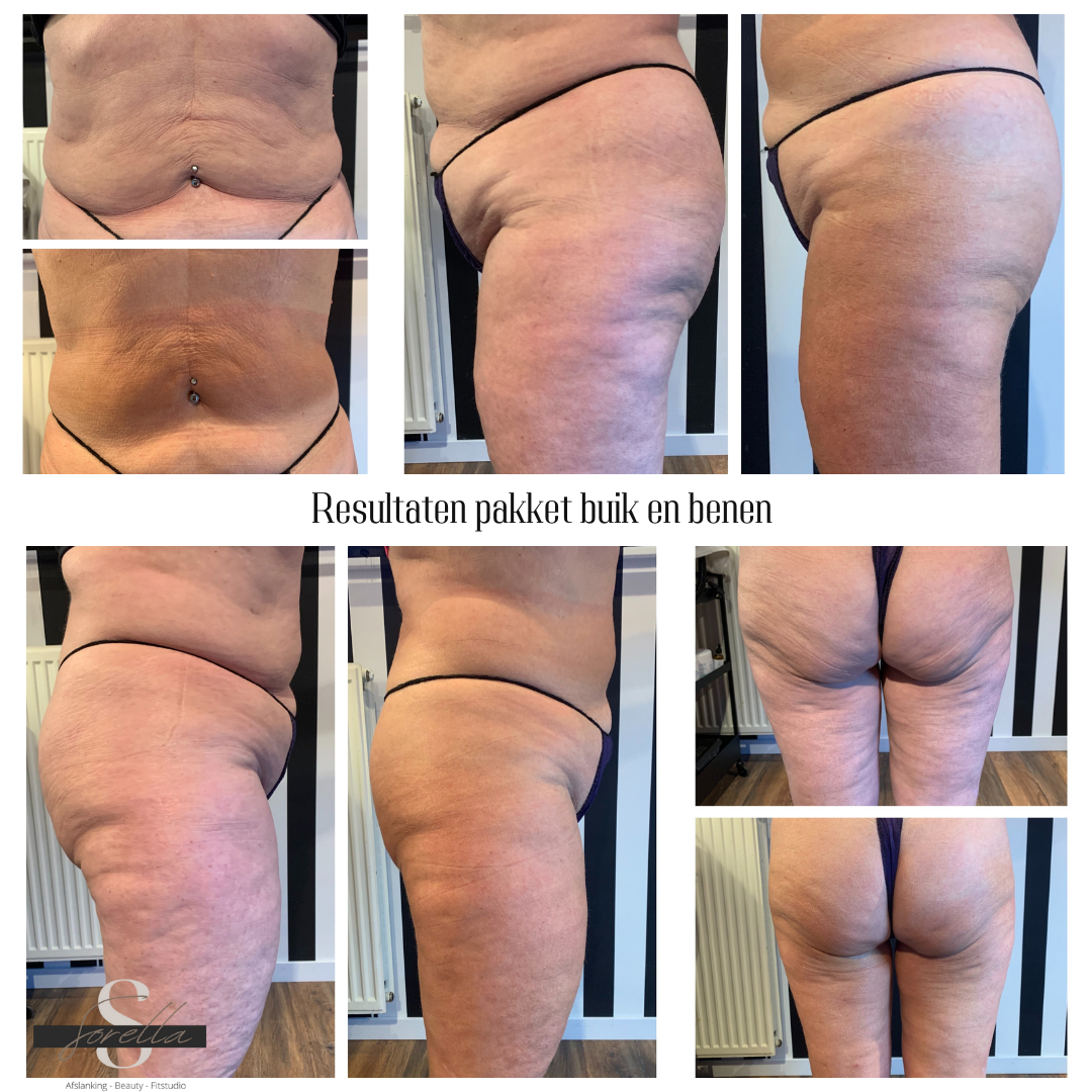 Bodywrap cellulite + afslanking