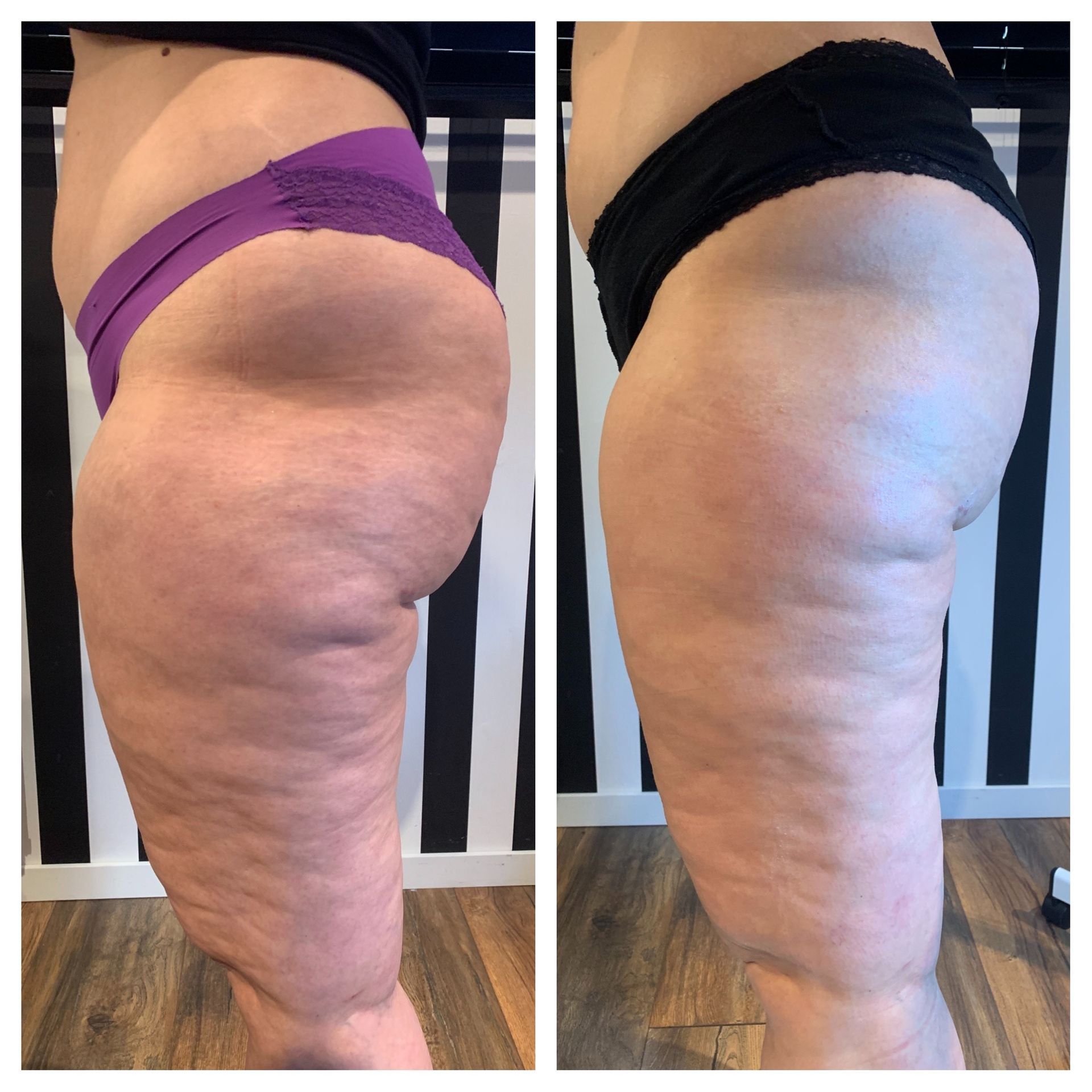 Bodywrap cellulite + afslanking