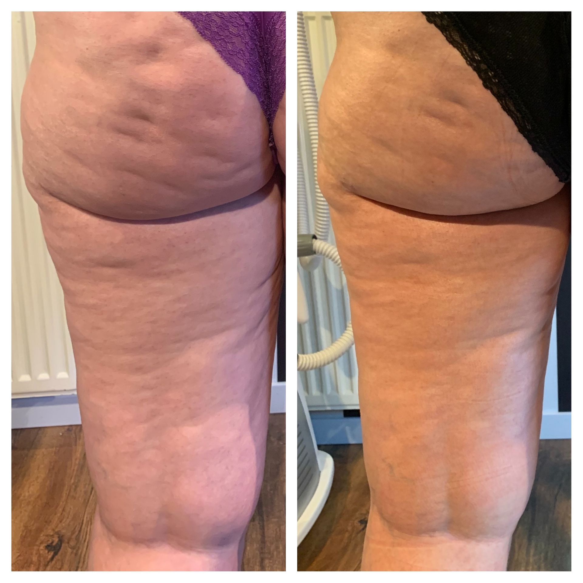 Bodywrap cellulite + afslanking