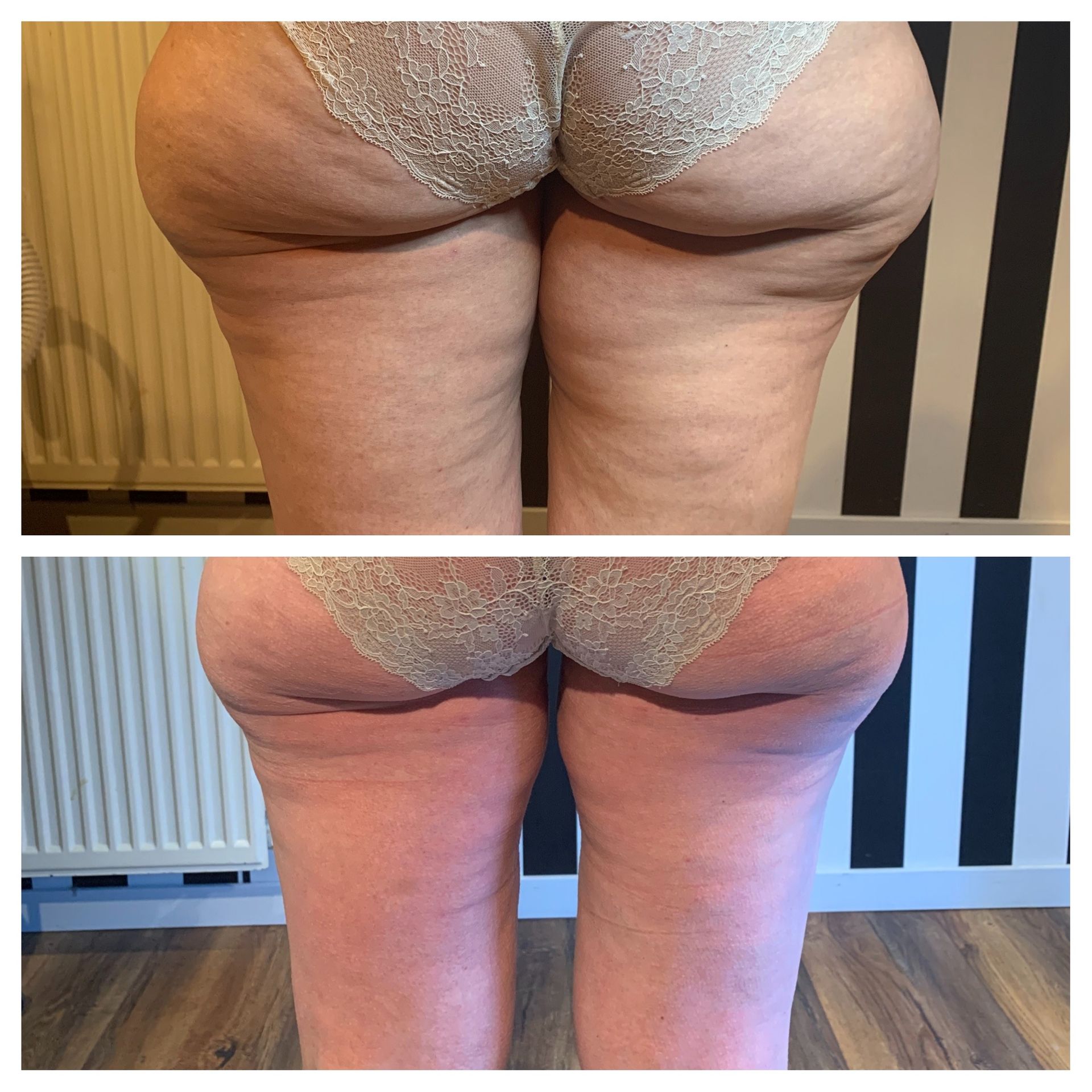 Bodywrap cellulite + afslanking