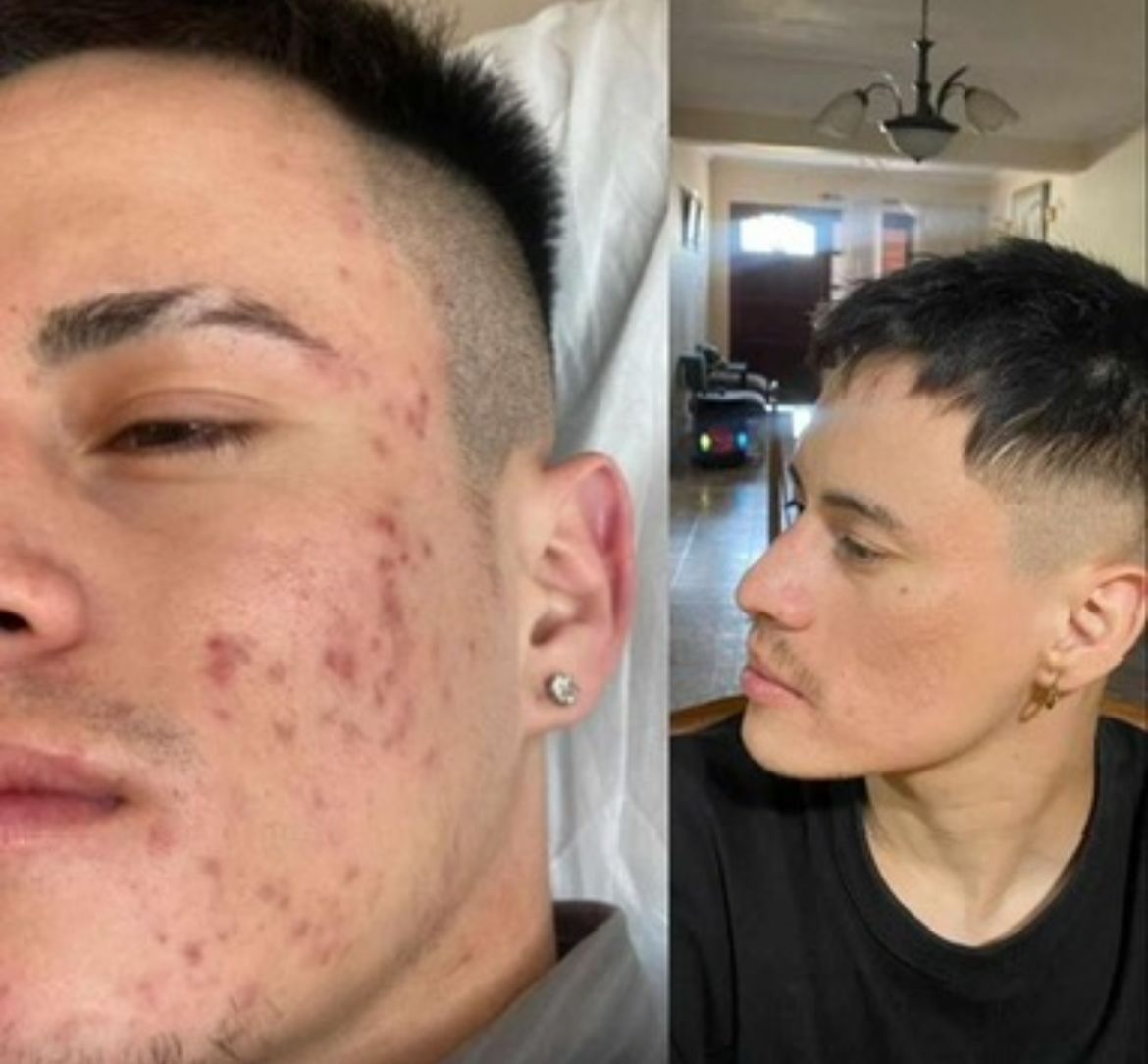 Antes y después del tratamiento para el acné