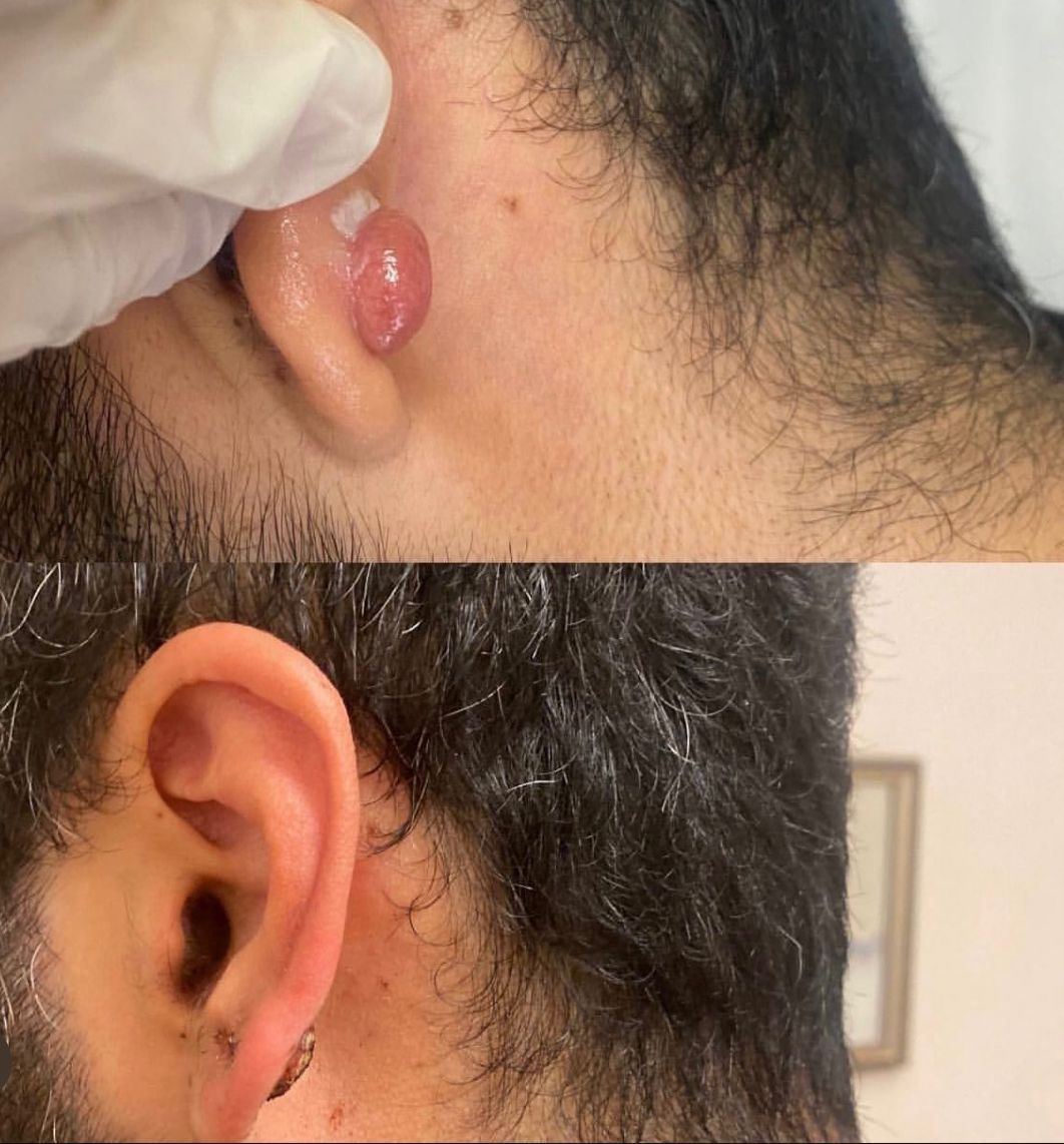 Arriba: Oreja con una protuberancia roja grande. Abajo: La misma oreja después de eliminar la protuberancia.
