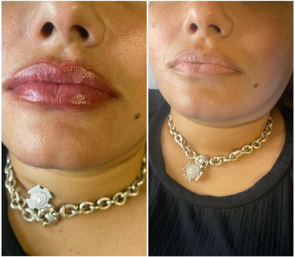 Comparación de los labios de una persona. 