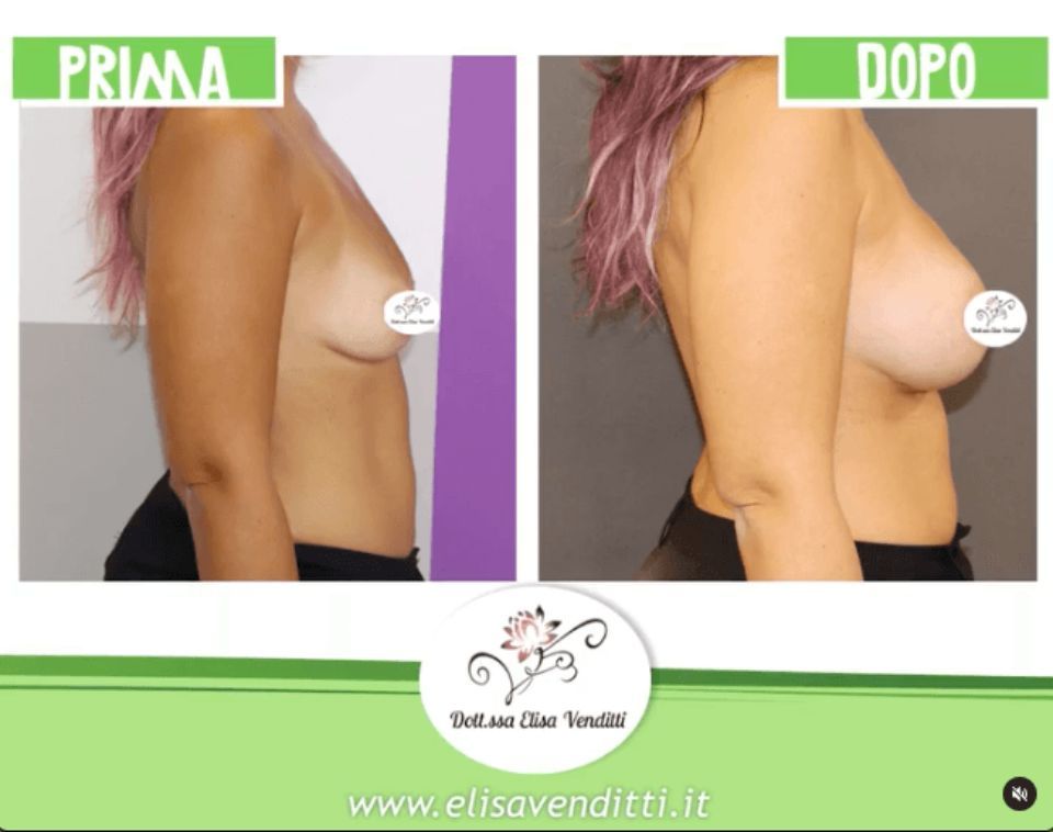 Chirurgia del seno prima e dopo