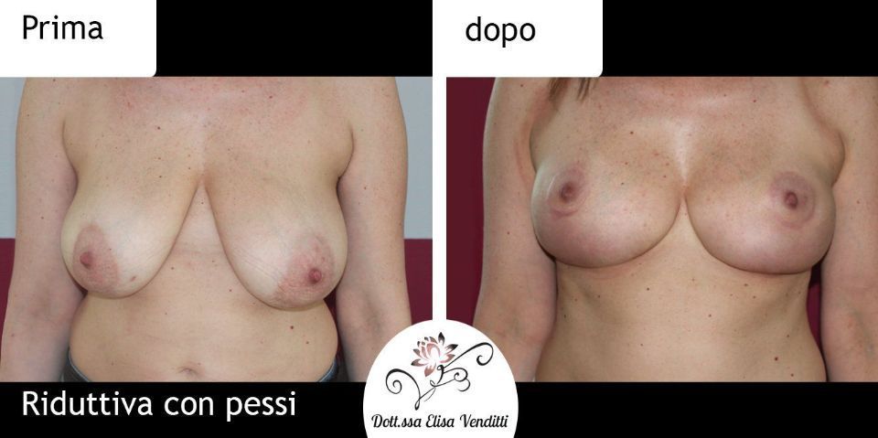 Chirurgia riduzione seno prima e dopo