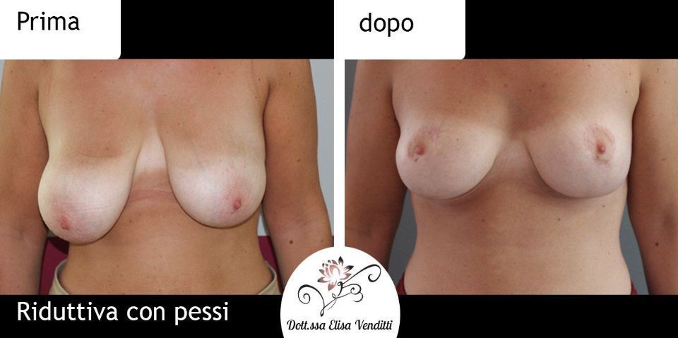 Mastoplastica riduttiva prima e dopo
