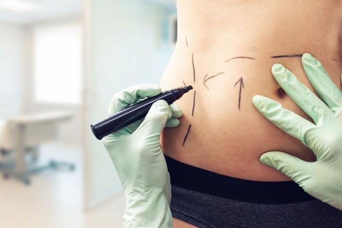 Lipofilling