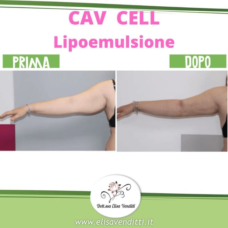 Lipoemulsione prima e dopo