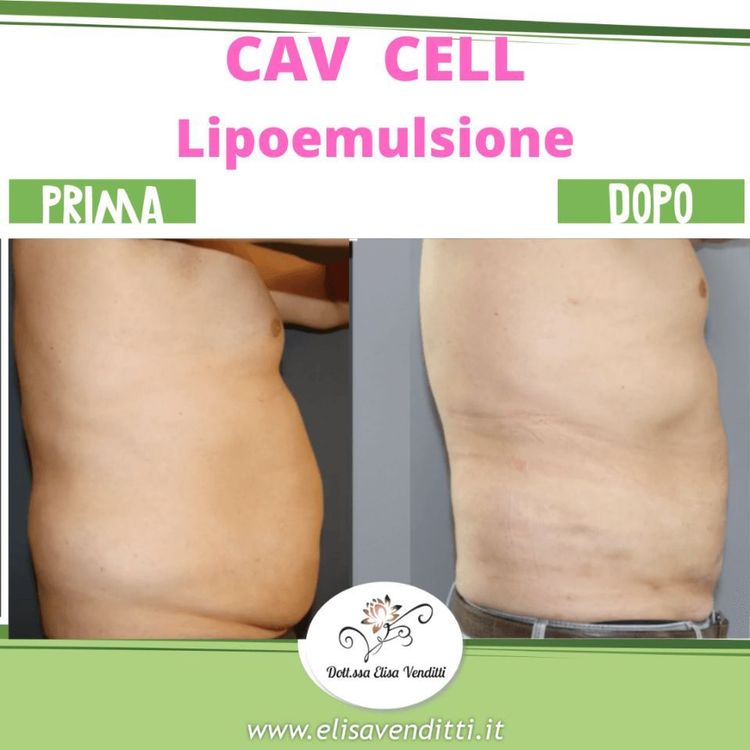 Lipoemulsione con CavCell