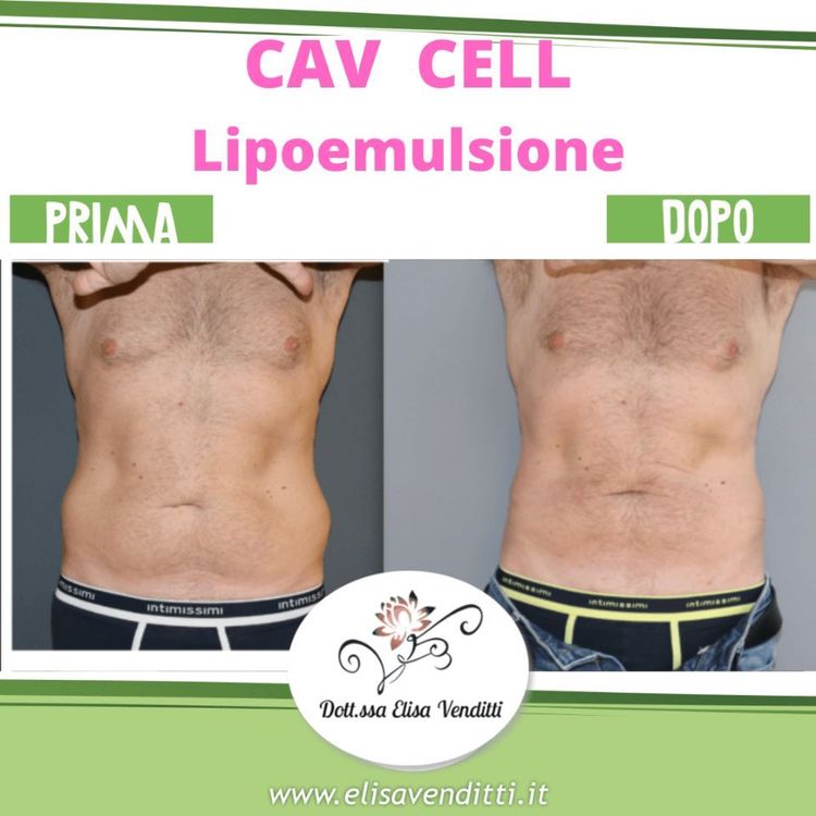 Lipoemulsione addome uomo