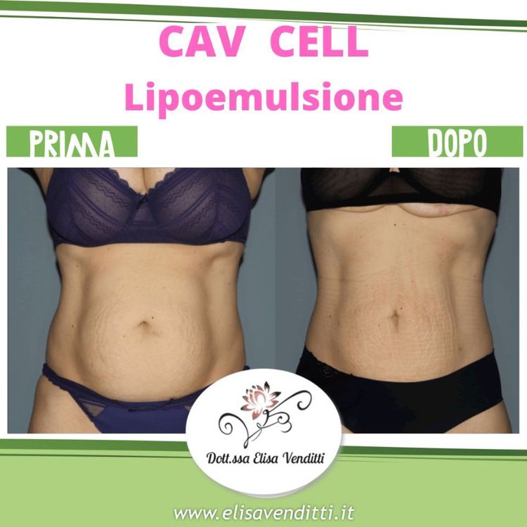 Lipoemulsione addome donna