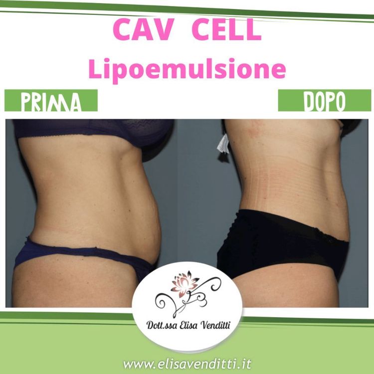Lipoemulsione corpo donna