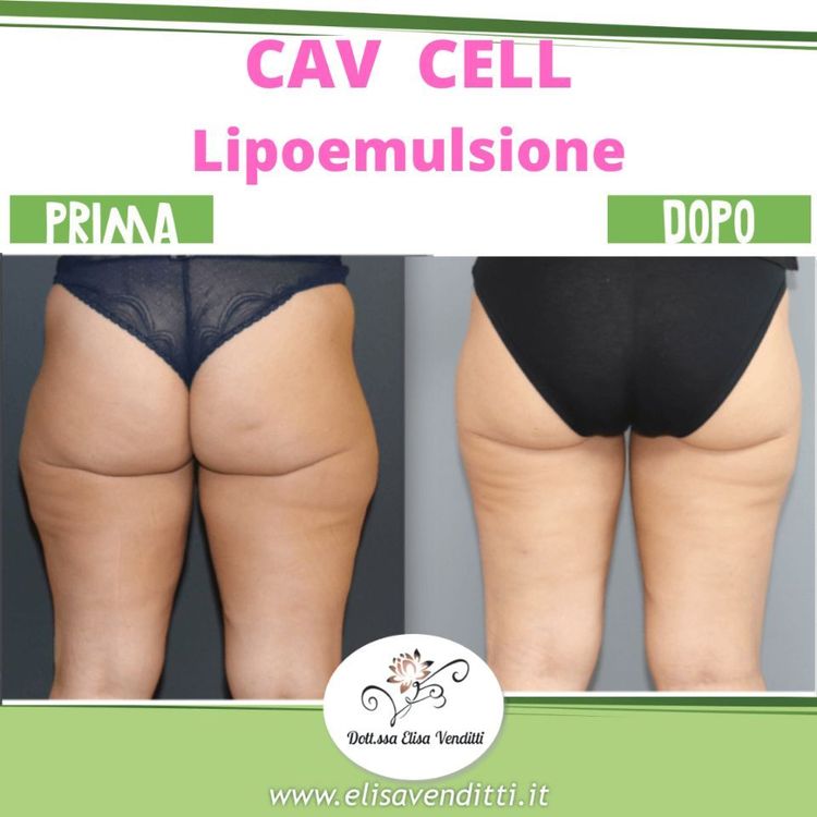 Lipoemulsione glutei