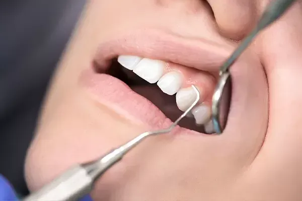 A dentist uses a mirror and a dental explorer to examine a patient's teeth.