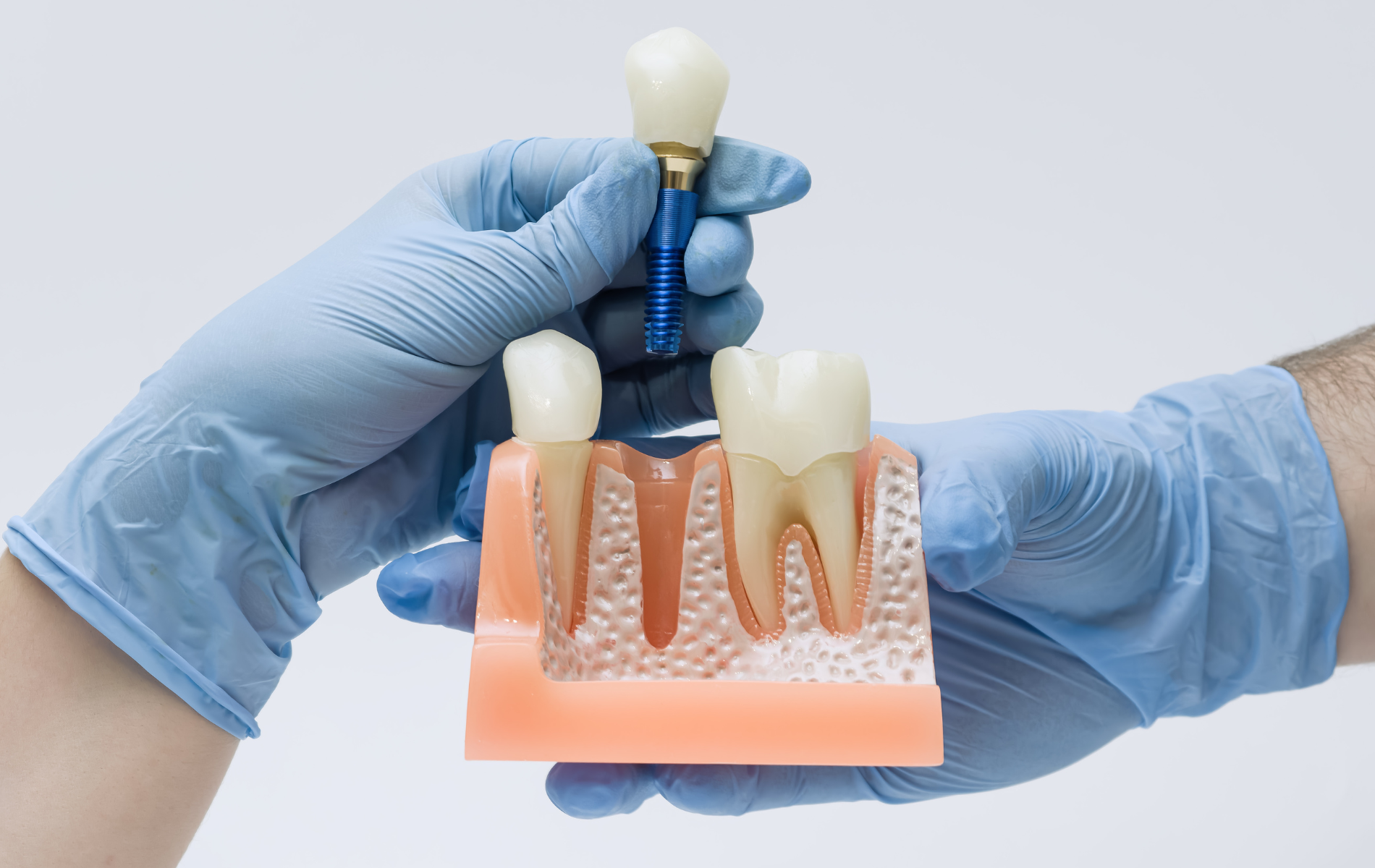 Hands in blue gloves holding a dental model demonstrating a tooth implant procedure.