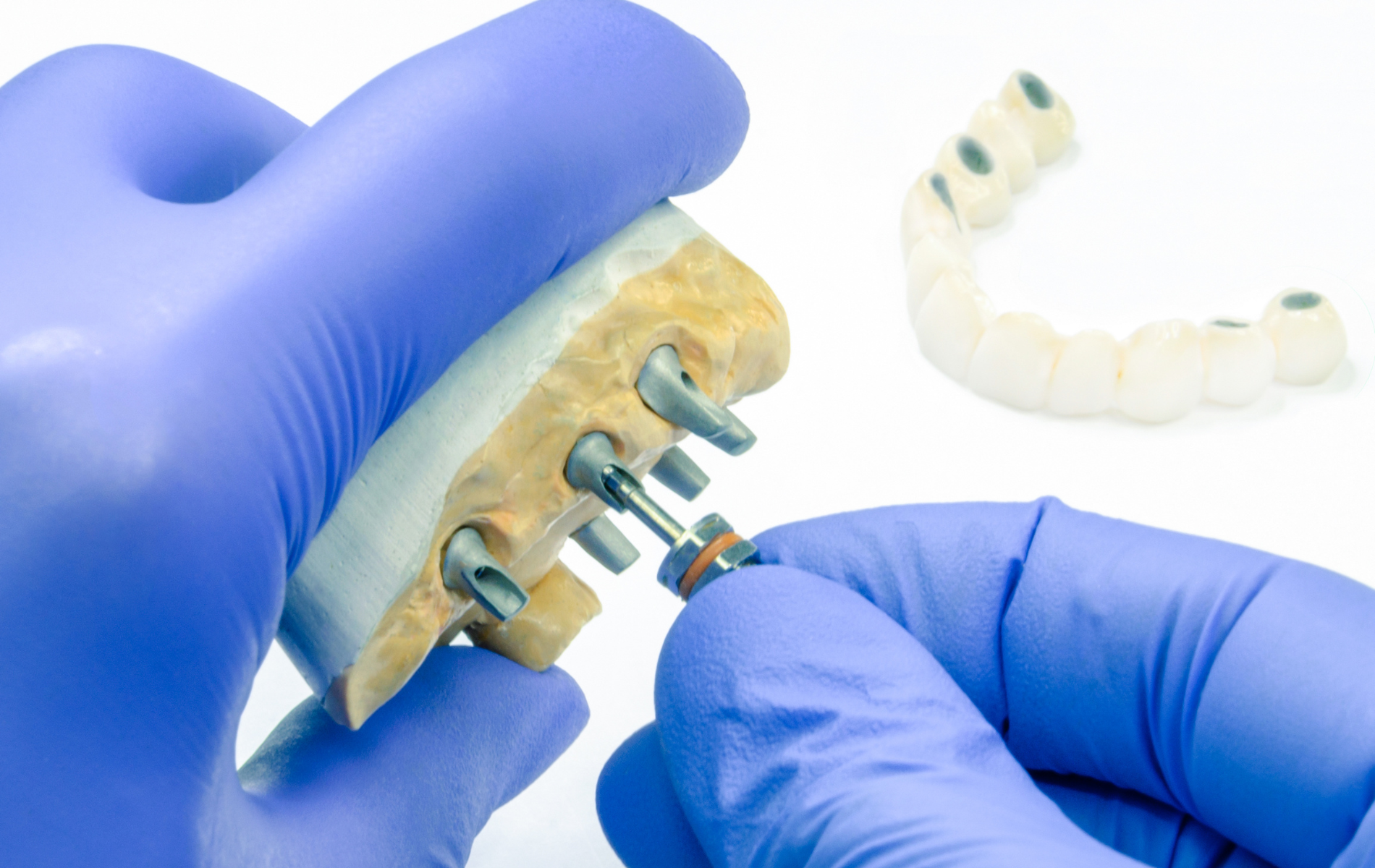 Gloved hands assembling a dental implant bridge onto a stone model of a jaw.