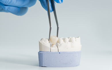 A dental professional in blue gloves uses tweezers to place a crown onto a stone dental model.