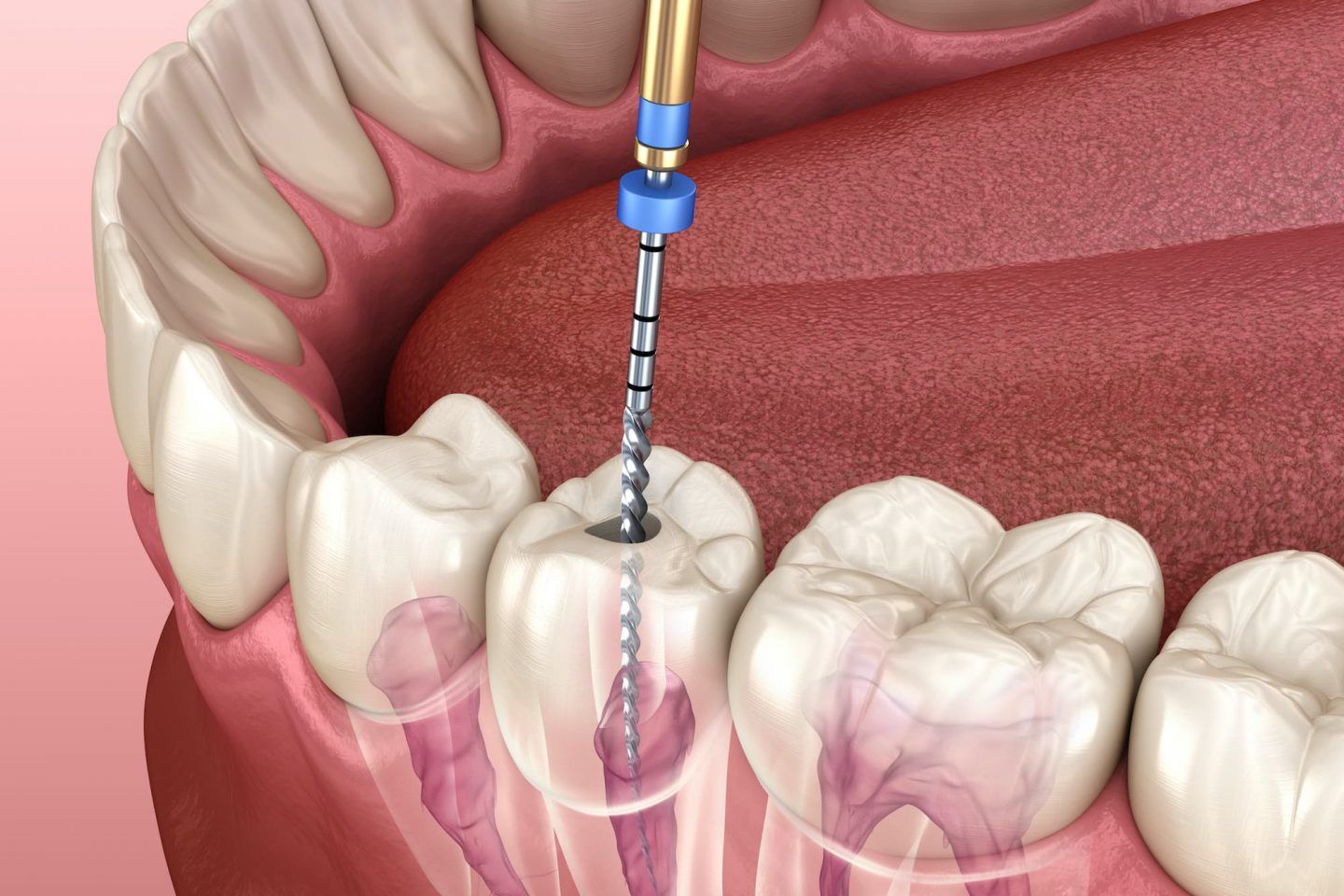 A dental drill inserts a file into the root canal of a human molar to perform an endodontic procedure.