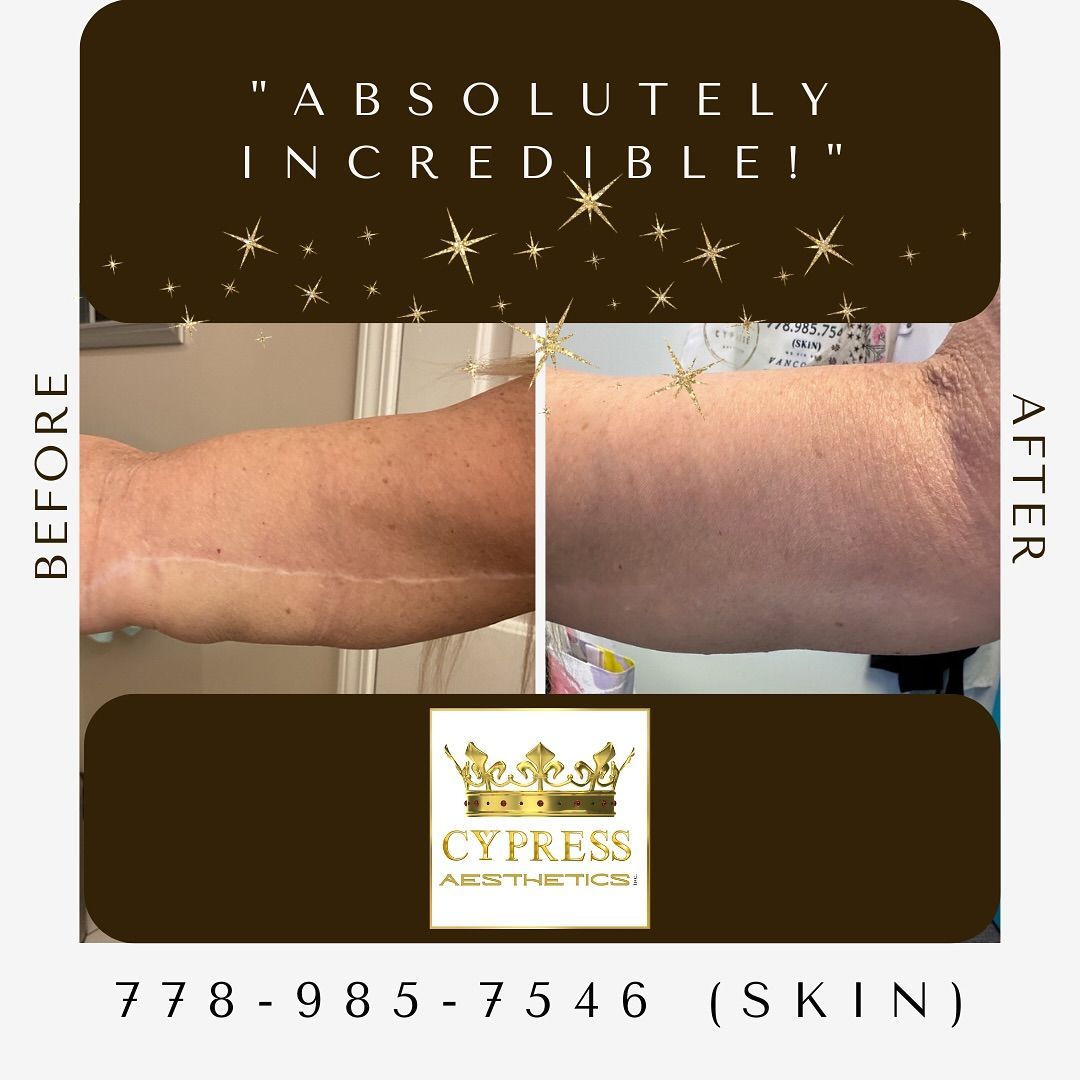 Camouflage Tattoo Results