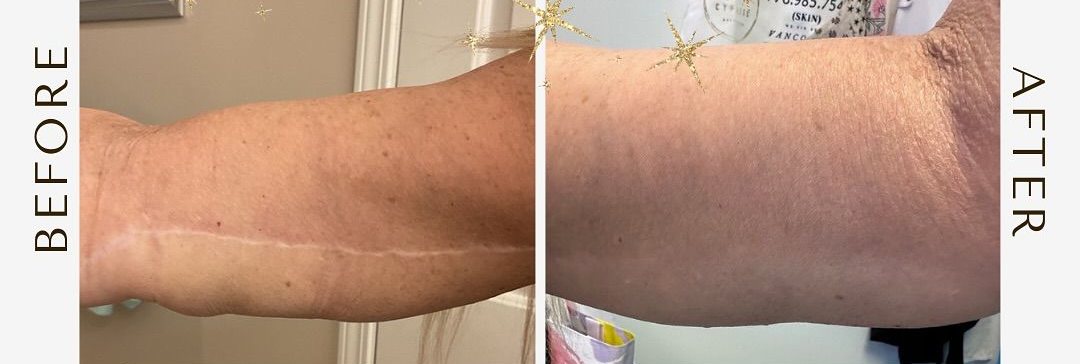 Before and after comparison of an arm, showing a scar reduction or skin camouflage tattoo treatment result.cypress aesthetics inc.