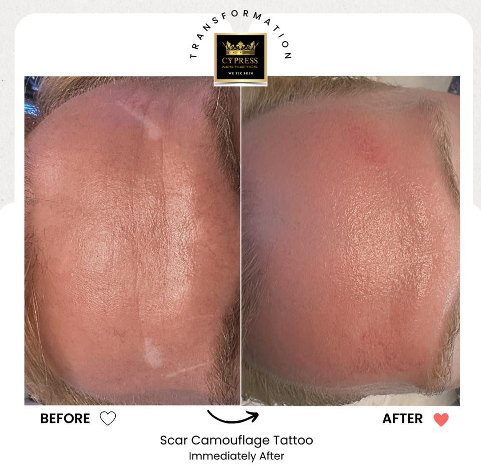 camouflage tattoo Vancouver @cypressaesthetics