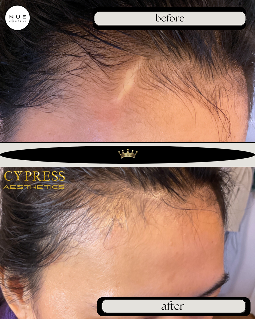 Paramedical Tattoo Expert Vancouver Cosmetic Tattoo Camouflage Inkless Tattoo cypress aesthetics 