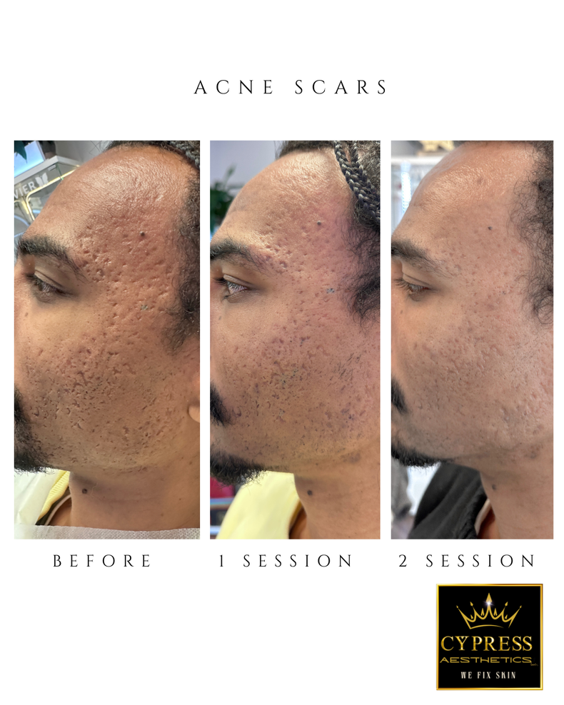 before and after results after only 2 treatments acne scars are gone
