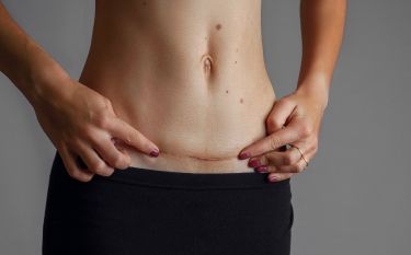 A woman is holding her stomach with a scar on it.