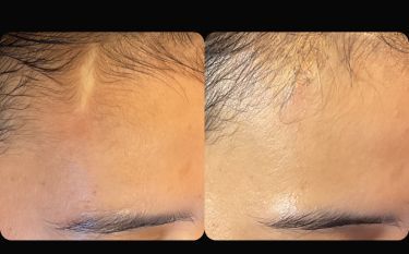 A before and after photo of a woman 's forehead with a scar.