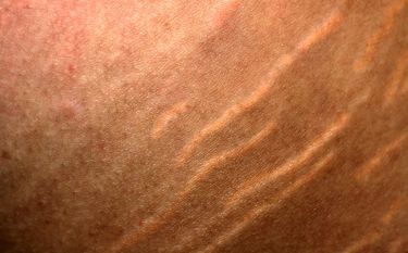A close up of a person 's skin with stretch marks.