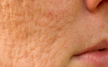 A close up of a person 's face with acne on it.