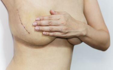 A woman is holding her breast with a scar on it.
