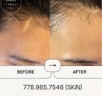 A before and after picture of a man 's forehead.