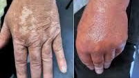 A side-by-side comparison of a hand with pale, patchy skin on the left and a red, swollen hand on the right.