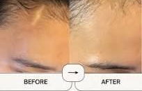 A before-and-after comparison showing the treatment of a forehead scar, with the camouflage tattoo in second image. Cypress Aesthetics Inc. Vancouver