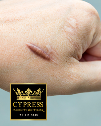 keloid treatment
