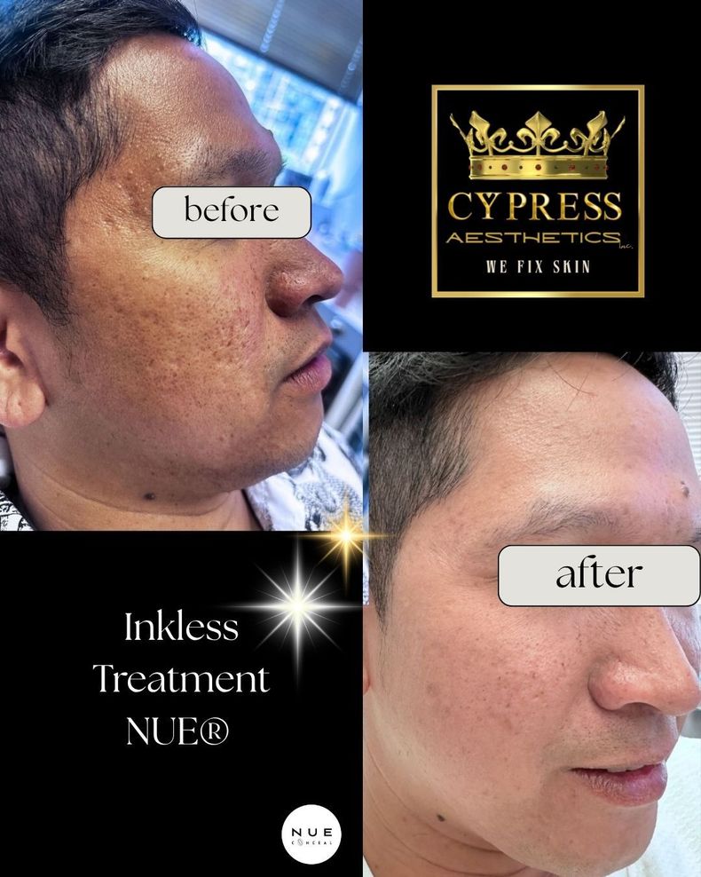 A close up of a person 's face with acne on it.