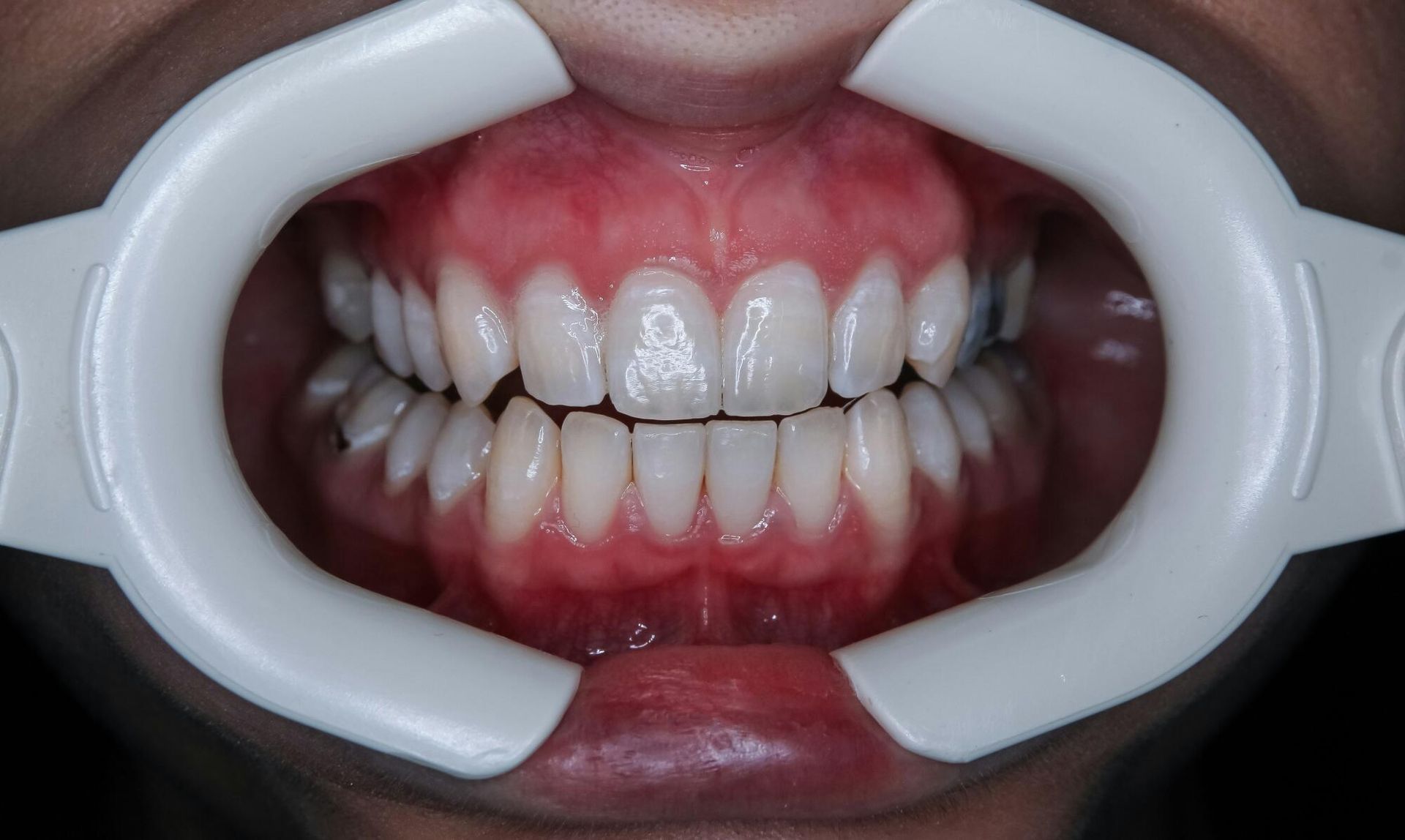 A close up of a person 's teeth with a mouth guard.