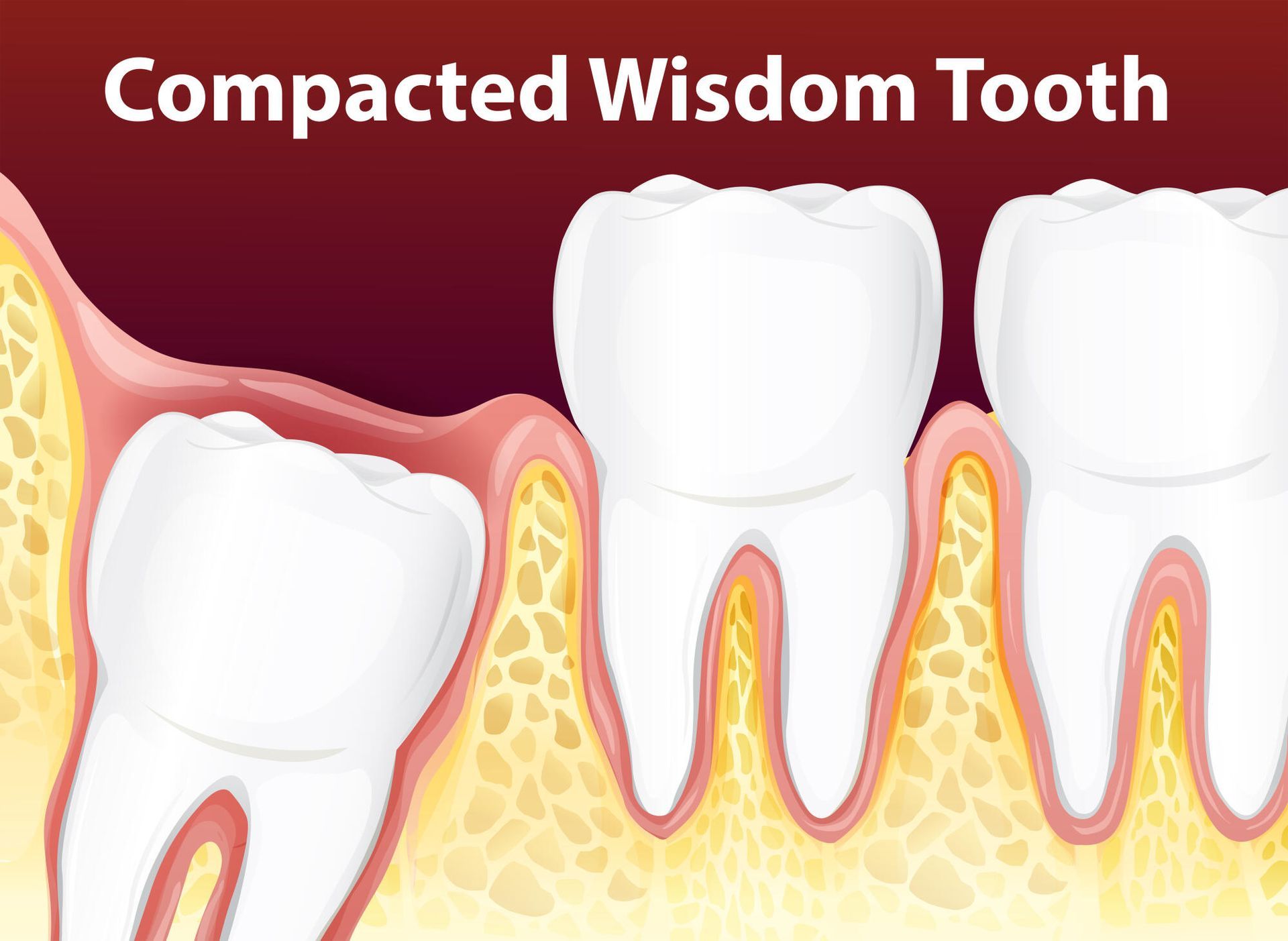 An illustration of a compacted wisdom tooth