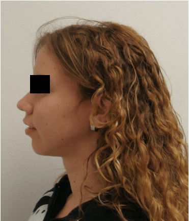 Facial Implants – Chin, Cheek and Jaw