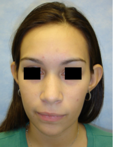 Otoplasty
