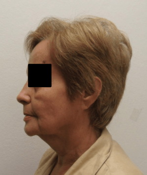 Rhytidectomy