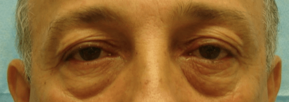 blepharoplasty